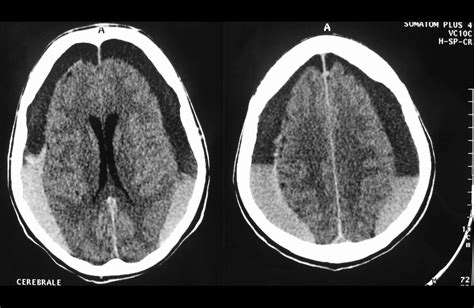 Hematoma Subdural Neuro Recovery