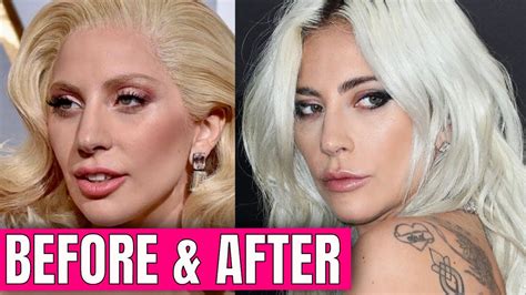 lady gaga nose job before after