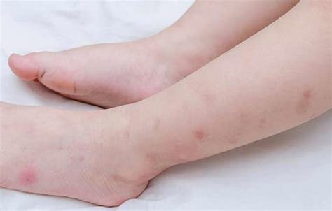 Bed Bug Rash On Skin Pictures Treatment Allergy And Symptoms Pestbugs