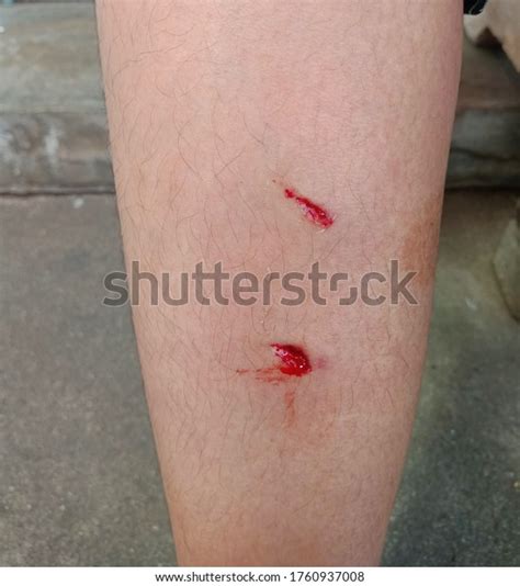 Get Wound Due Dog Biting On Stock Photo 1760937008 Shutterstock