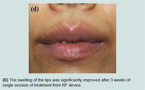 Avens Publishing Group Localized And Recurrent Angioedema Of The Lips