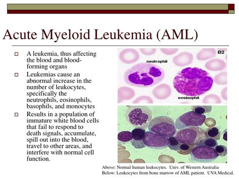PPT HOX A Connections To Acute Myeloid Leukemia PowerPoint Presentation ID