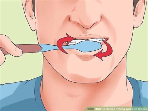 Ways To Handle Poking Wires On Braces Wikihow