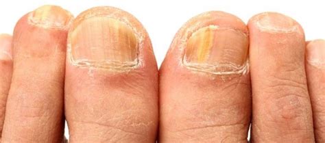 Fungal Nail Infection Laser Treatment Premier Clinic