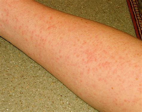 Mononucleosis rash are considered to be delayed type. Amoxicillin Rash - Pictures, Causes, Treatment and Risks ...