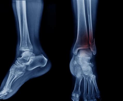 Treating Your Achilles Tendon Tear Part I Non Surgical Treatments