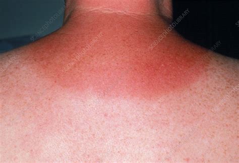 Sunburnt Neck Due To Overexposure To Sun Stock Image M3350090