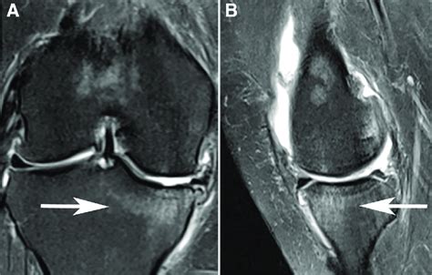 Bone Medullary Lesion Involving The Medial Tibial Plateau Of The Right