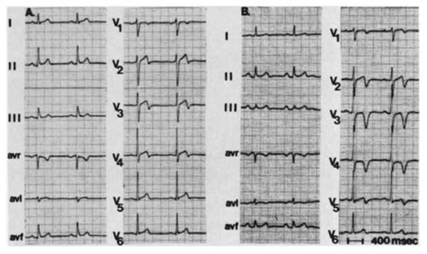 Contoh Gambar Ekg Stemi 43 Koleksi Gambar