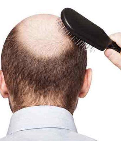 After completing 9 months of my treatment, i can clearly see the transformation of my hair. How to Cure Male Pattern Baldness | Consult Dr Batra's™