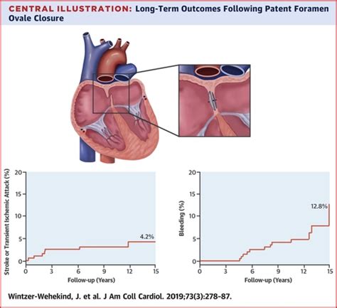 Long Term Follow Up After Closure Of Patent Foramen Ovale In Patients