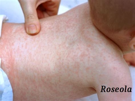 Measles Rubella Roseola Or Fifths The Vienna Report