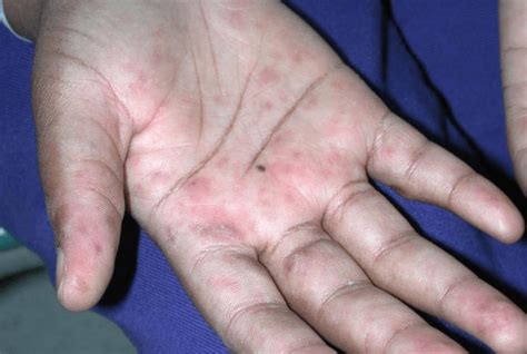 Common Causes And Treatments For Itchy Palm