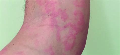 Figure B Multiple Erythematous Plaques On The Arm 5 Hours After