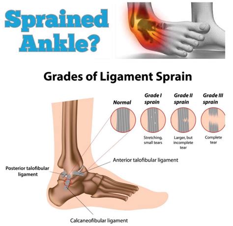 Elevates Ankle Sprain Rehab Elevate Physical Therapy