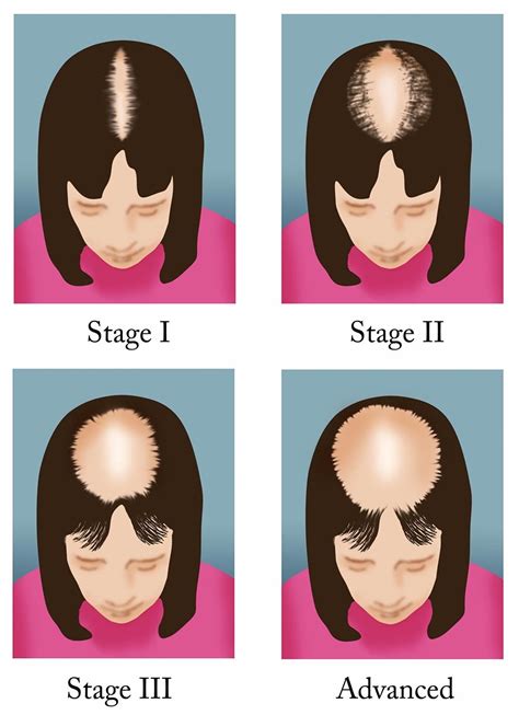 Medical For Us Hair Loss Types Cause Prevention Treatment