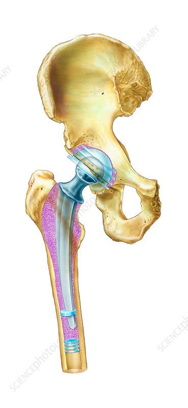 Hip Replacement Artwork Stock Image C007 6906 Science Photo Library
