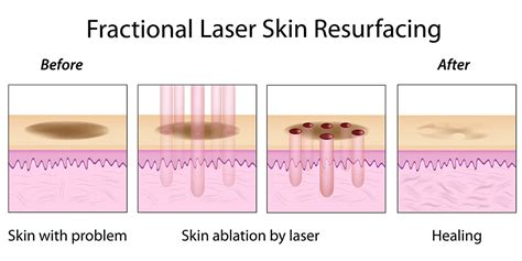 Laser Skin Resurfacing Melbourne Ozmedica Aesthetic Clinic