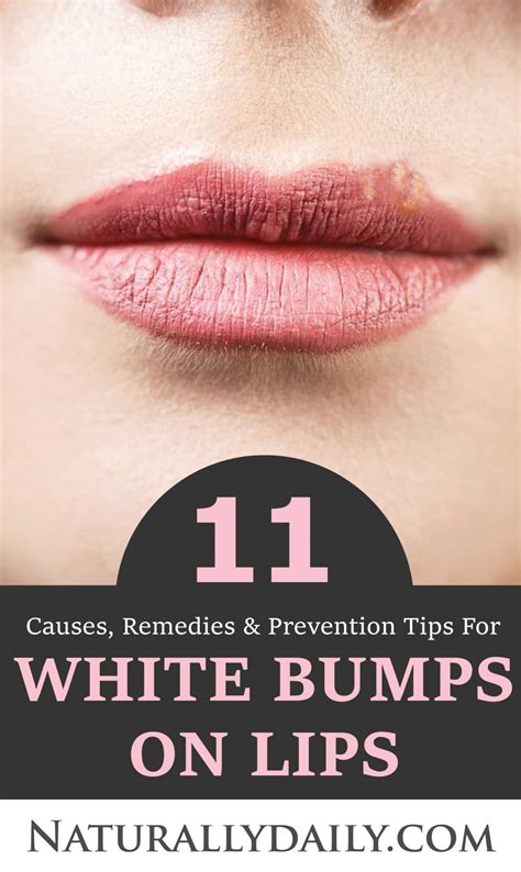 White Bumps On Lips Causes Remedies Prevention Tips Naturally Daily