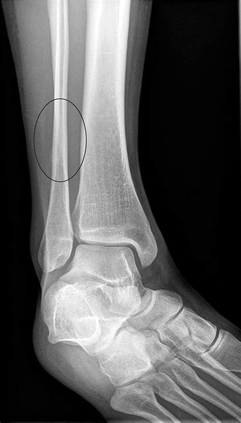Stress Fracture Foot And Shin Causes Symptoms Prevention And Treatment