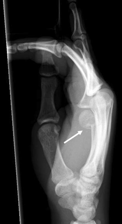 Lateral Radiograph Of A Boxers Fracture Arrow Download Scientific