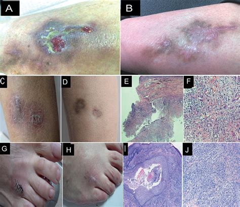 Cutaneous Infections Caused By Rapidly Growing Mycobacteria Case