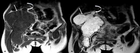 Mri Coronal Images Reveal A Large Lobulated Mass Lesion In The Right