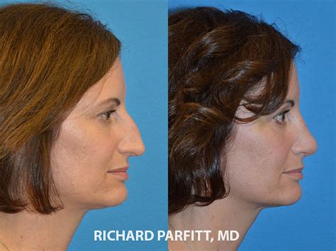 Plastic Surgery Before And After Nose Jobs