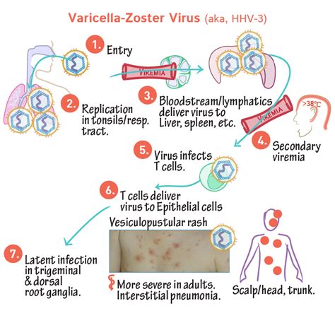 Immunologymicrobiology Glossary Varicella Zoster Virus Aka Hhv 3