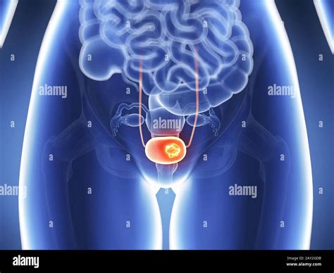 Bladder Cancer Hi Res Stock Photography And Images Alamy