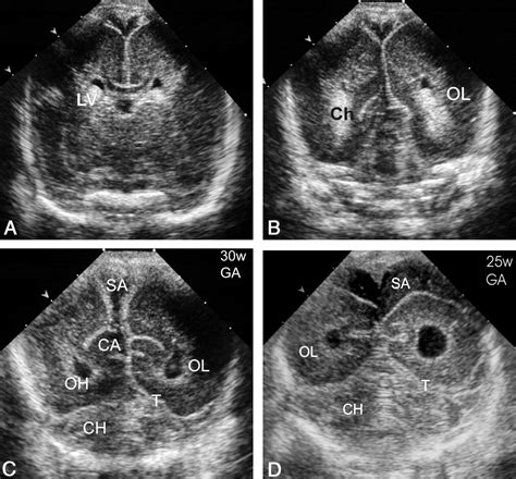 Posterior Fontanelle Sonography An Acoustic Window Into The Neonatal