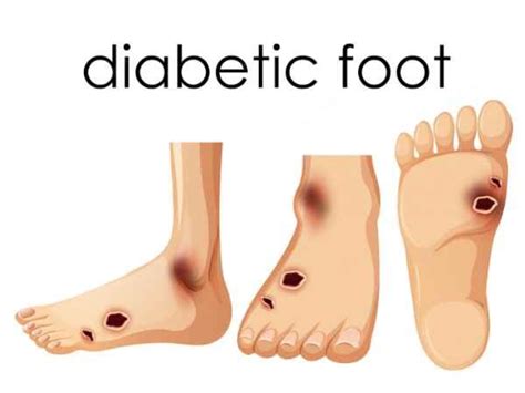 Diabetic Foot Treat It Before Its Too Late Agva Healthcare