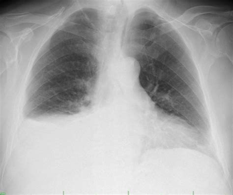 Postero Anterior Pa Chest Radiograph Of The Patient Homogeneous