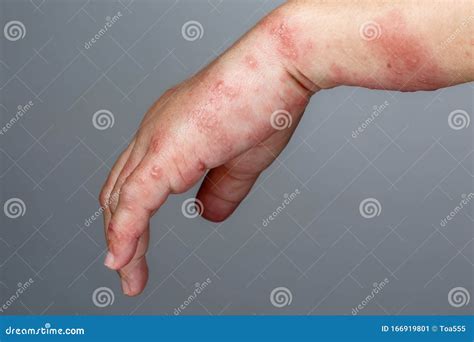 Shingles Symptoms Viral Infection That Causes A Painful Rash Medical