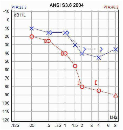 Understanding Your Audiogram