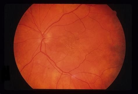Acute Posterior Placoid Pigment Epitheliopathy Retina Image Bank