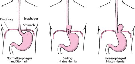 Hiatus Hernia Gastrointestinal Disorders Msd Manual Professional