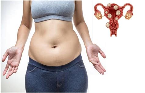 Do Fibroids Make You Gain Weight Public Health