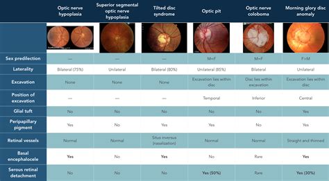 Congenital Optic Disc Anomalies — Ophthalmology Review 2023
