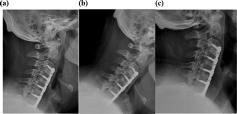 Clinical Outcomes After Four Level Anterior Cervical Discectomy And