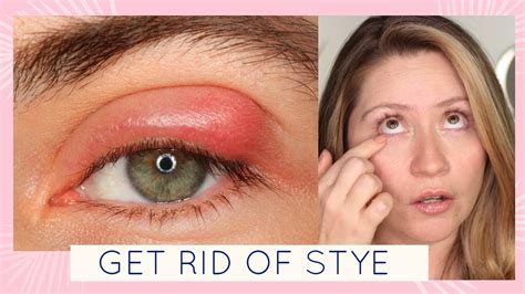 How To Get Rid Of A Stye Youtube