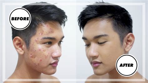 Guys Wearing Makeup To Er Acne Scars Tutorial Pics