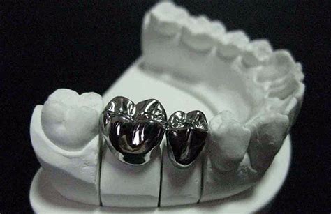 Stainless Steel Dental Crown News Dentagama