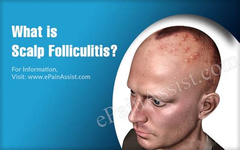 Folliculitis Of The Scalp Stock Image C Science Photo Library My XXX