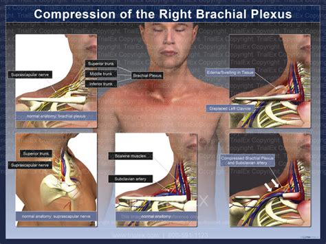 Compression Of The Right Brachial Plexus Trial Exhibits Inc