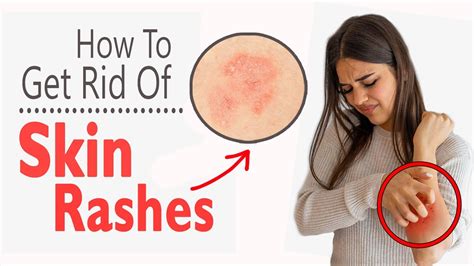 How To Get Rid Of Skin Rashes Naturally Home Remedies For Skin