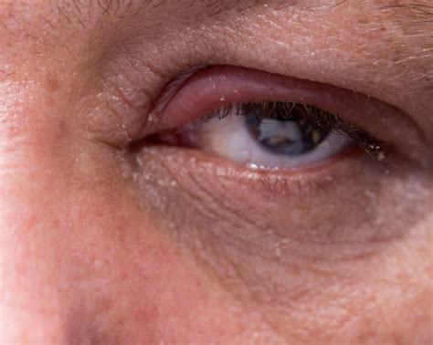 Blepharitis Causes Symptoms And Treatment
