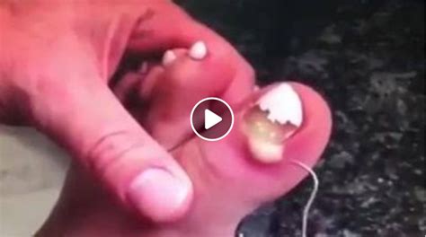 Toe Nail Pimple Popping Viral On The Web Now