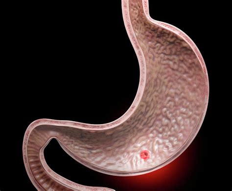 Stomach Ulcer Photograph By Tim Vernon Science Photo Library