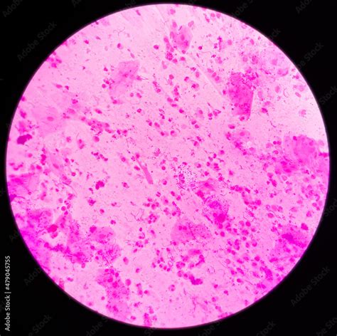 Sputum Gram Stain Microscopic View Show Plenty Pus Cells And Few Epithelial Cells With Plenty